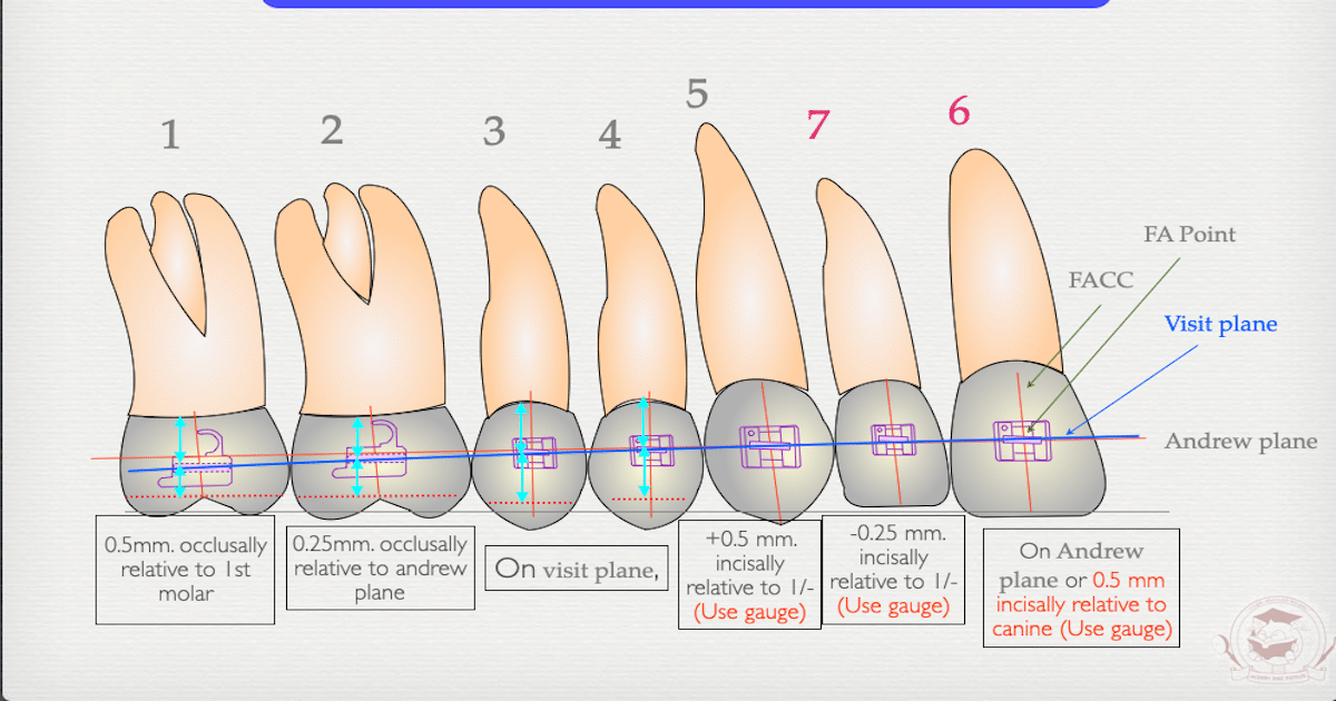 Bracket Position and Smile Line สอนจัดฟันระบบ AVS